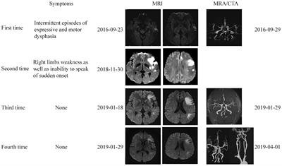 Hyoid Elongation May Be a Rare Cause of Recurrent Ischemic Stroke in Youth-A Case Report and Literature Review